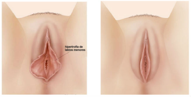 labiaplasty